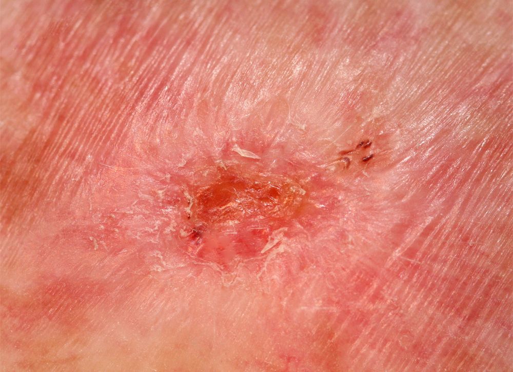 Hautkrebsvorstufen Aktinische Keratose
