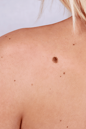 Hautkrebs oder nicht, Fachärzte der Dermatologie wie Dr. Zorn untersuchen sehr gründlich
