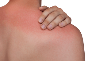 Rote Haut nach Sonnenbrand schädigt die Haut und erhöht das Risiko für Hautkrebs