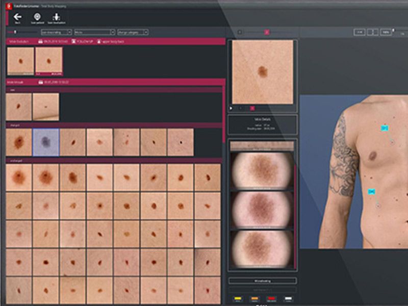 Hautkrebsvorsorge Untersuchung einer Gewebeprobe