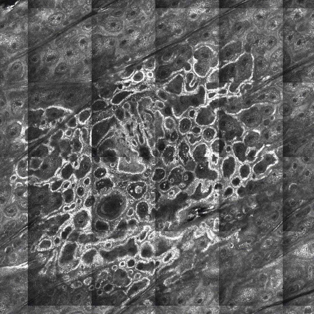 Gerasterte Bildpunkte Konfokales Laser Mikroskop Hautzellen Krebs